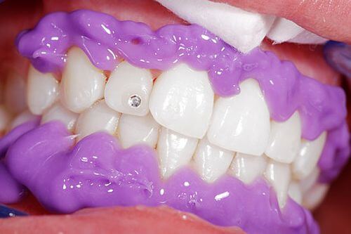 Gingiva Protector Schutzgel beim Zahnbleaching - weissezaehnebleaching.de