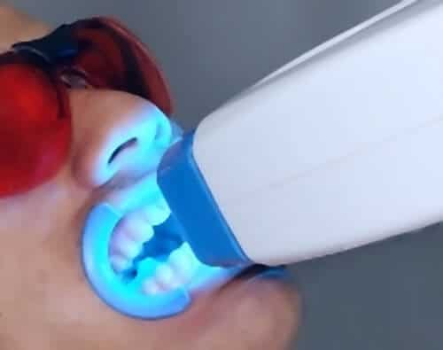 Professionelles Zahnbleaching mit LED-Licht - weissezaehnebleaching.de